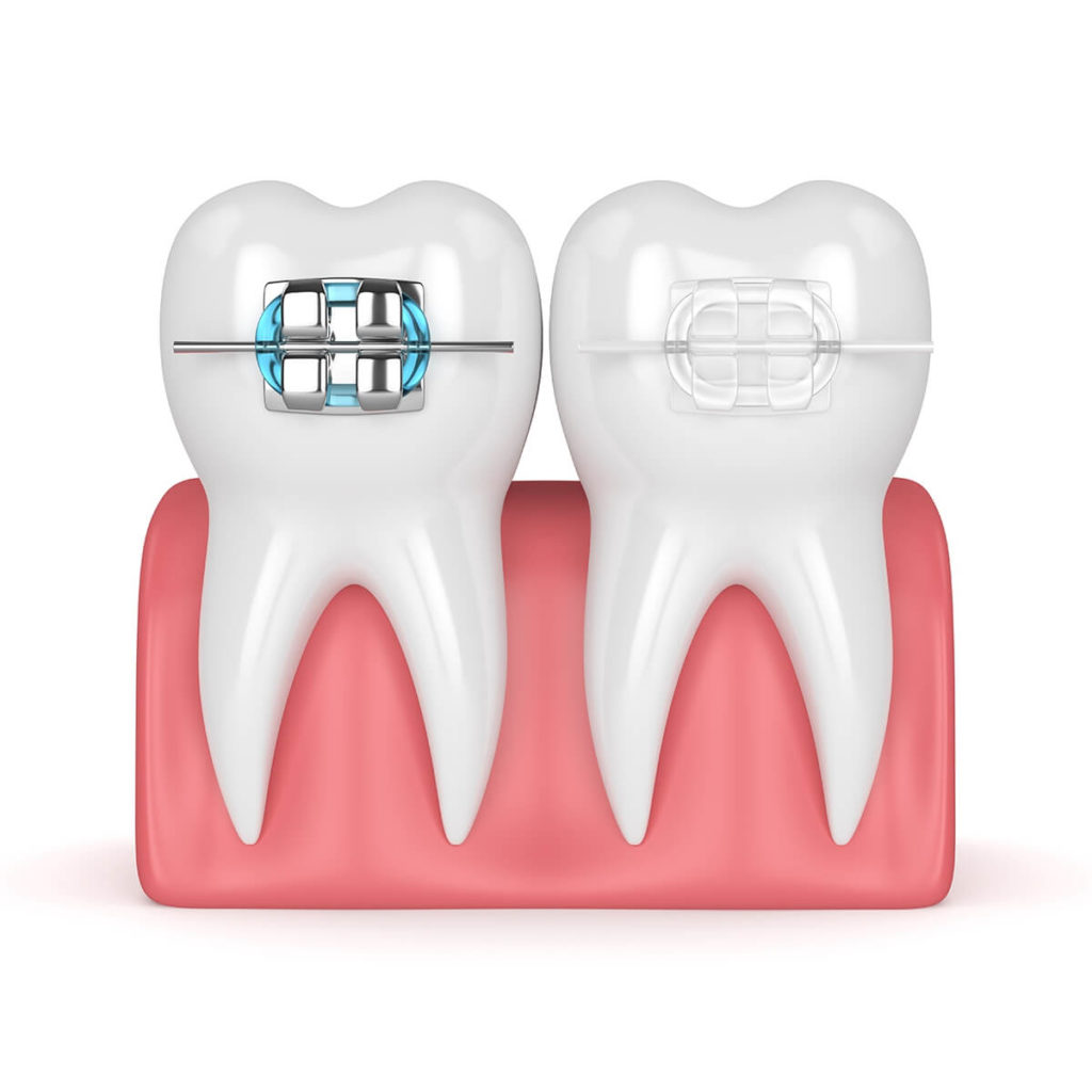 Frenos Transparentes | Bella Dental